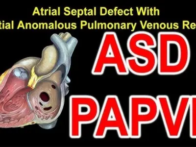 Partial Anomalous Pulmonary Venous Return (PAPVR) overview