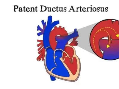 Patent Ductus Arteriosus (PDA) causes and prevention
