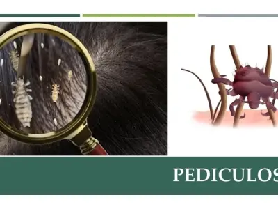 A clinical guide to diagnosing and treating pediculosis