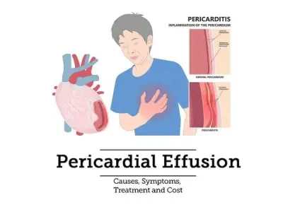 Pericardial Effusion Risk Factors you should know about
