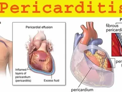 Pericarditis - Understanding the cause of your chest pain