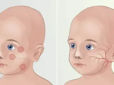 Phenylketonuria (PKU) - The importance of a lifelong low-protein diet