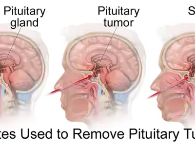 Pituitary tumors - Understanding these common brain tumors