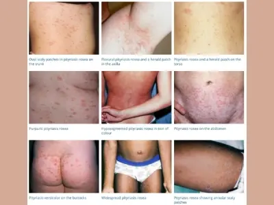 Understanding pityriasis rosea symptoms and causes