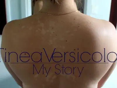 Effective topical treatments for pityriasis versicolor