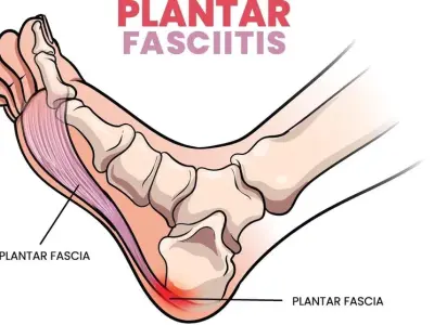 Stretches and exercises to manage plantar fasciitis