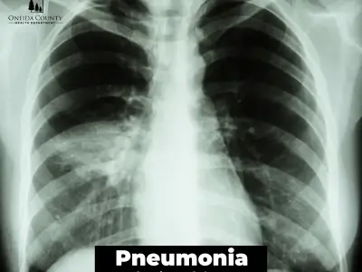 Pneumococcal disease - Symptoms and risks