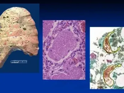 Pneumocystis pneumonia (PCP) in HIV/AIDS patients