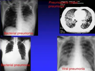 Understanding pneumonia and its main causes