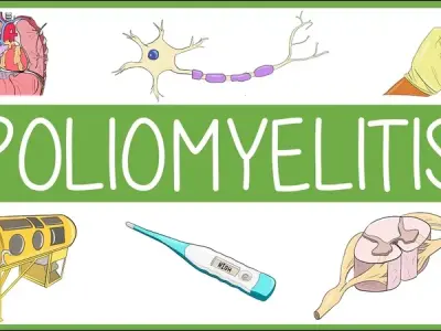 Acute flaccid myelitis vs. poliomyelitis - Key differences