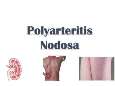 Key facts about Polyarteritis Nodosa you should know