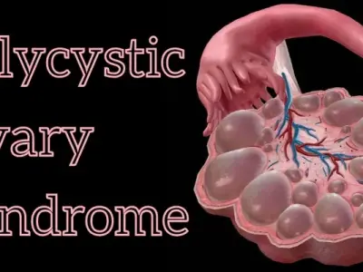 Managing polycystic ovary syndrome with diet and lifestyle