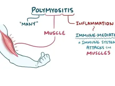 Polymyositis - What are the key signs to watch for?