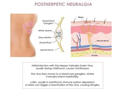 Post-herpetic neuralgia - Managing pain after a shingles rash