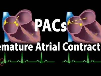 Premature Atrial Contractions (PACs) symptoms guide