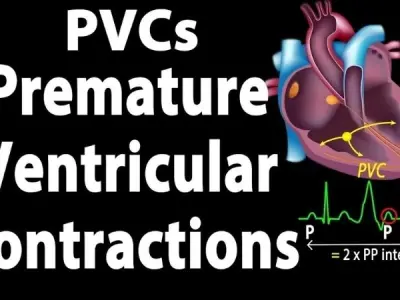 Premature Ventricular Contractions (PVCs) causes and risks