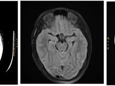 Understanding primary amebic meningoencephalitis