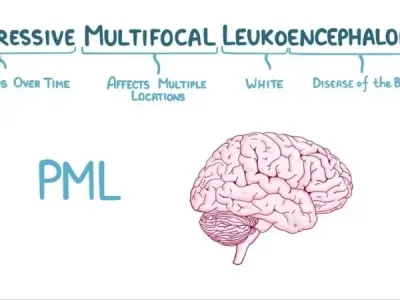 Understanding progressive multifocal leukoencephalopathy