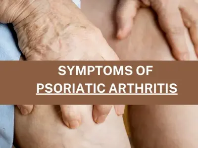 Recognizing dactylitis and enthesitis in psoriatic arthritis