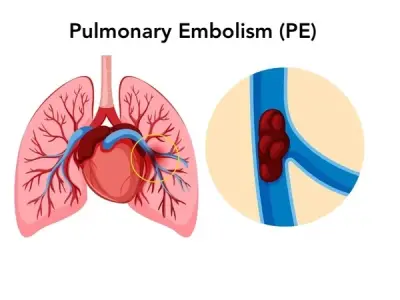 Pulmonary embolism - A guide to symptoms and treatment
