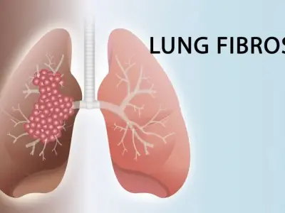 Pulmonary fibrosis - Understanding idiopathic scarring of the lungs