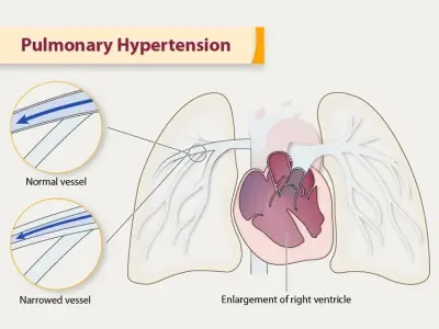 Recognizing the subtle early signs of pulmonary hypertension