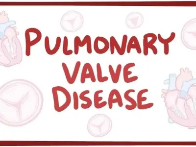 Pulmonary regurgitation (insufficiency) symptoms explained