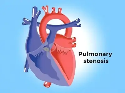 Pulmonary stenosis causes symptoms and treatment guide