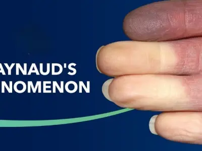 Raynaud's Phenomenon causes symptoms and treatment guide