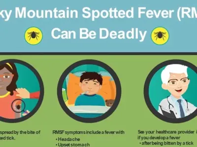 The tell-tale rash of rocky mountain spotted fever explained