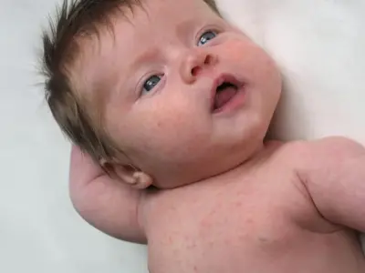 Roseola - Understanding human herpesvirus 6 (HHV-6)