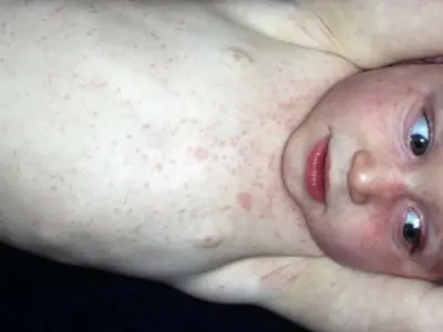 Understanding roseola infantum symptoms and treatments