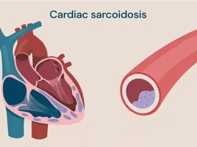 Sarcoid Cardiomyopathy diagnosis signs and management