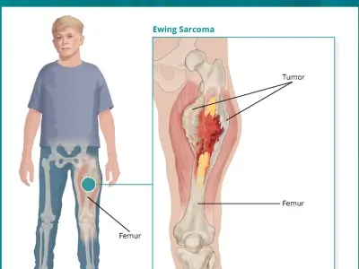The importance of diagnosis at a specialized sarcoma center