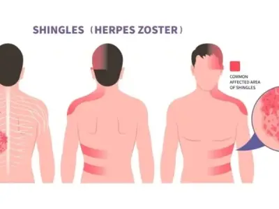Shingles (Herpes Zoster) what to expect and how to heal