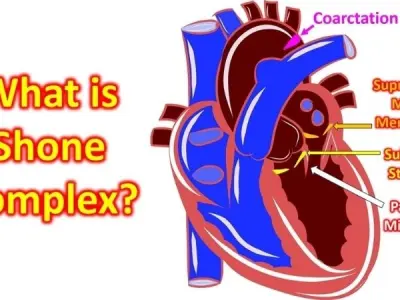 Exploring Shone's Complex causes risks and outcomes