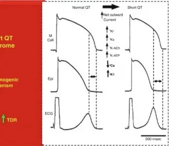 Understanding Short QT Syndrome (SQTS) and its impact