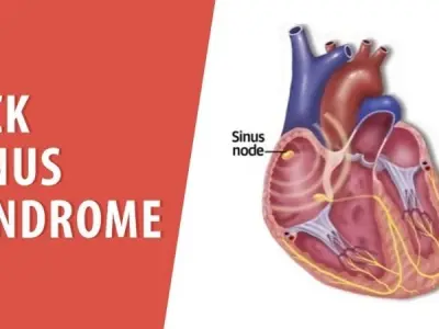 Sick Sinus Syndrome (Sinus Node Dysfunction) symptoms