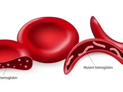 Sickle cell anemia - Understanding the inherited blood disorder