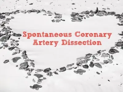 Spontaneous Coronary Artery Dissection (SCAD) overview