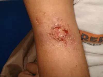 Systemic sporotrichosis in immunocompromised hosts