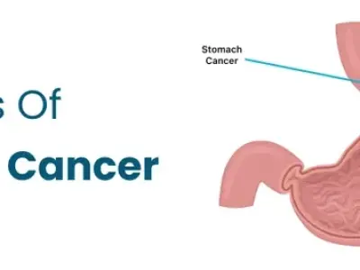 Diagnosing and staging stomach cancer for effective treatment