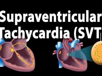 Managing Supraventricular Tachycardia (SVT) effectively