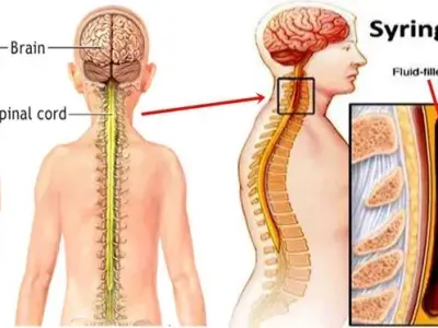What causes syringomyelia and how is it diagnosed?