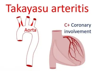 Takayasu's Arteritis signs causes and prevention methods