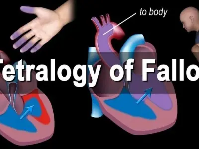 Patent Tetralogy of Fallot diagnosis and latest care options