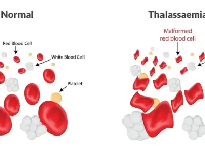 Thalassemia - From a minor trait to a major disease
