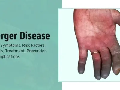 Causes of Thromboangiitis Obliterans (Buerger's Disease)