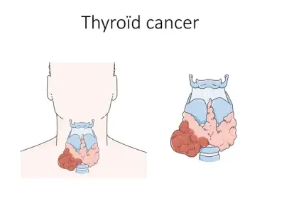 Thyroid cancer - A highly treatable but serious condition