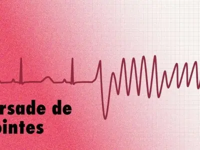 Torsades de Pointes causes symptoms and treatment guide